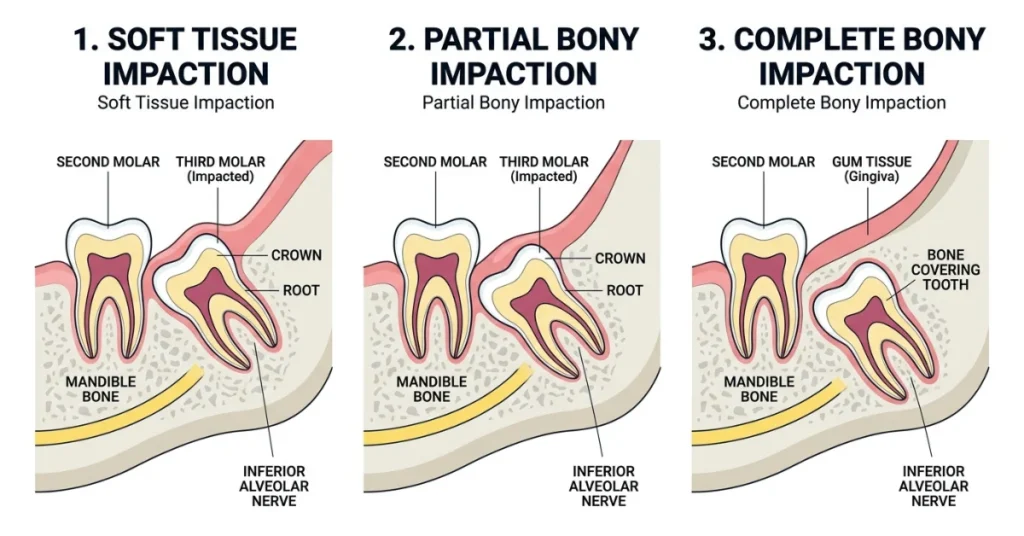 Diagram showing soft tissue, partial bony, and complete bony impacted wisdom teeth