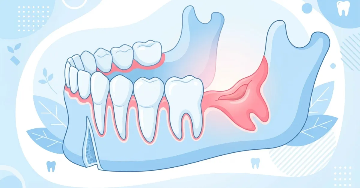 Medical illustration of a lower jaw showing an open tooth extraction socket