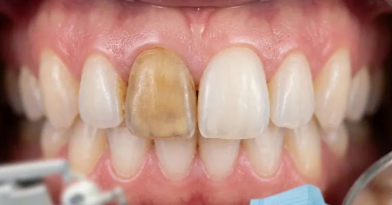 discolored tooth