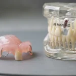 A 3D illustration of a 3-unit dental bridge replacing a missing tooth by anchoring to adjacent natural teeth.