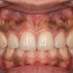 gum hyperpigmentation