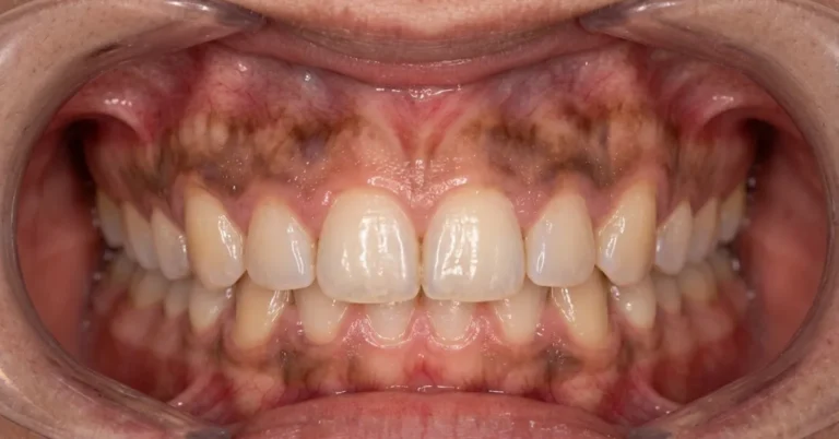 gum hyperpigmentation